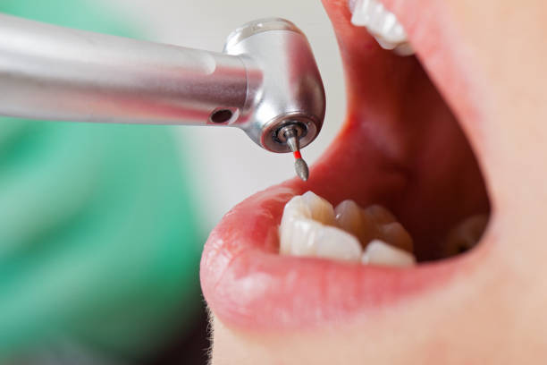 Best Emergency Tooth Extraction in Granite City, IL